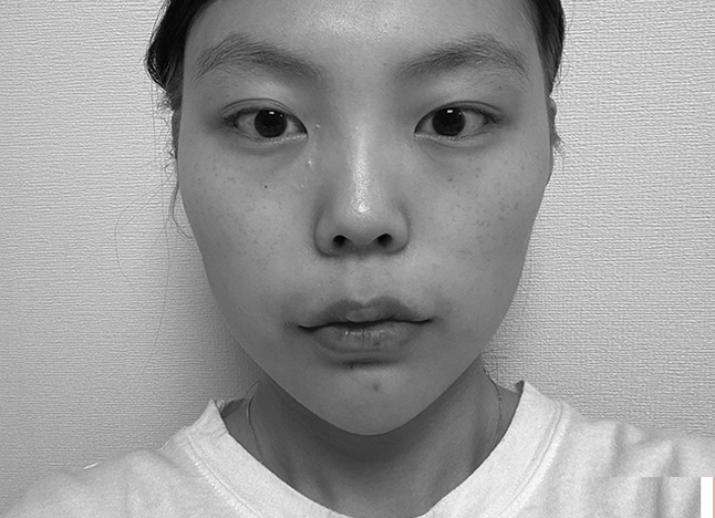 눈 before 이미지